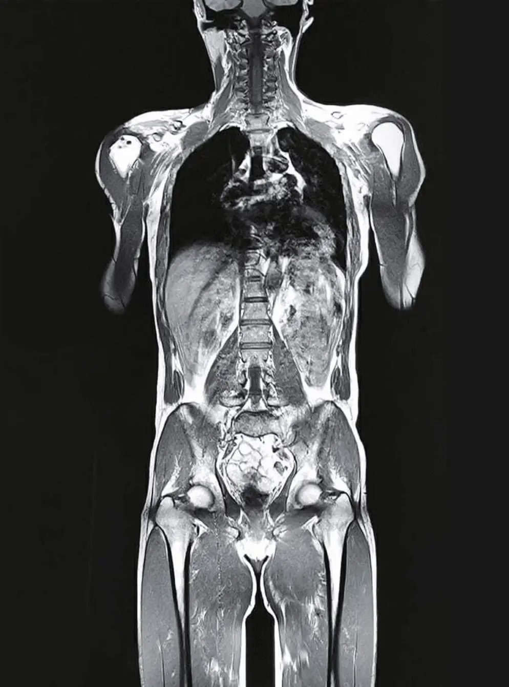Full-body MRI coronal view — torso from neck through pelvis