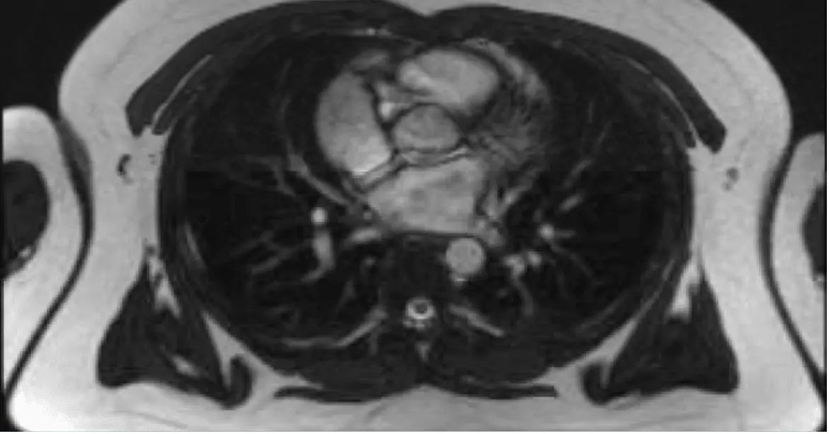 MRI axial slice — chest and heart region