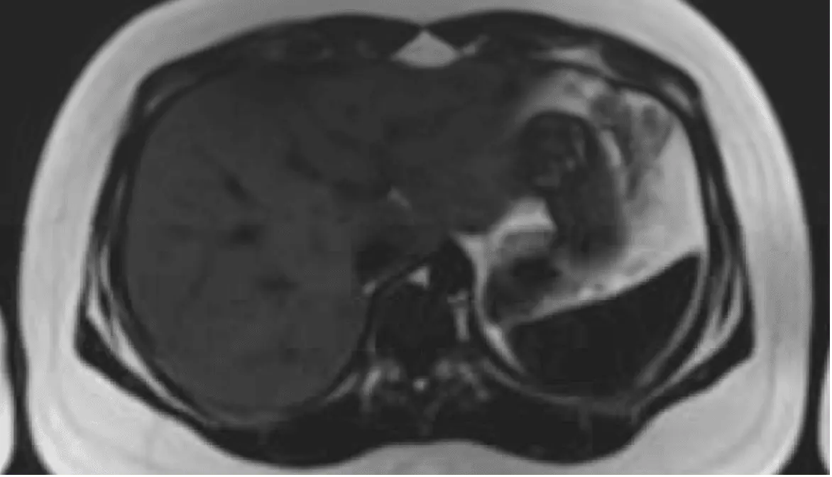 MRI axial slice — upper abdomen