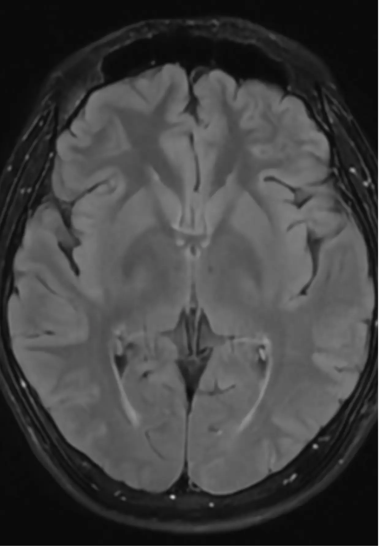 Brain MRI axial view — cerebral tissue and ventricular system