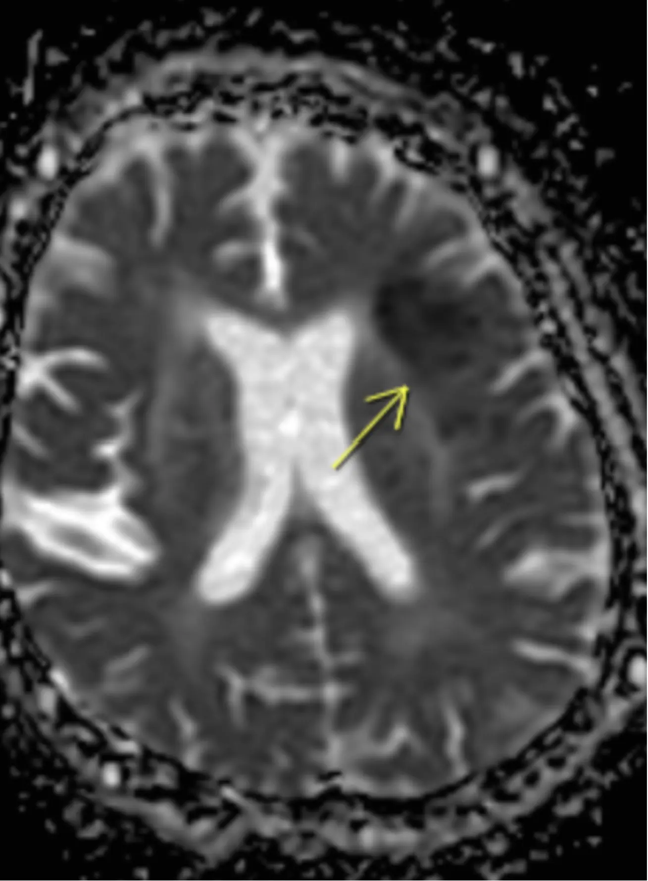 Brain MRI axial view — white matter and cranial nerve pathways