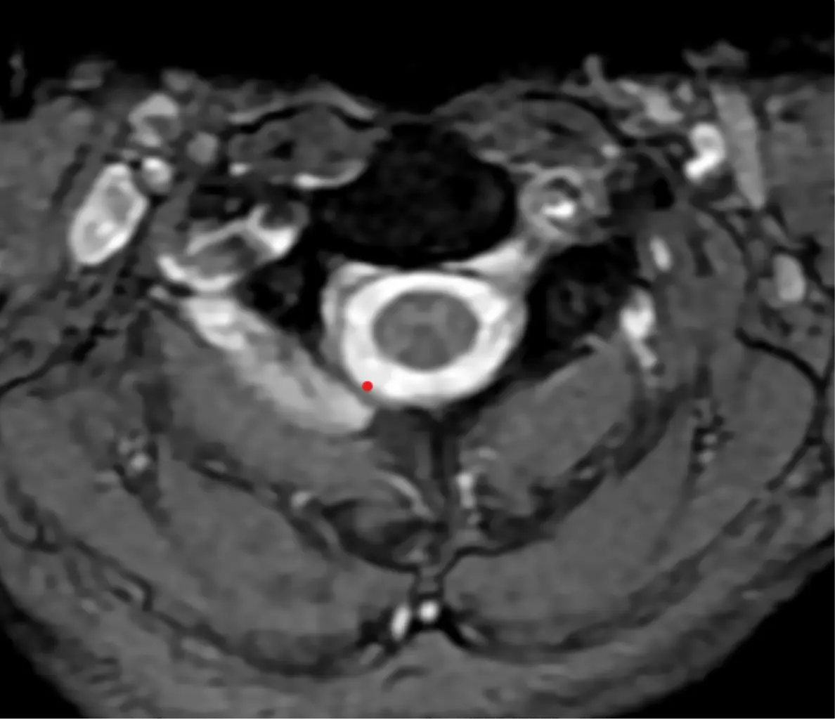 Spine MRI axial view — cross-section upper region