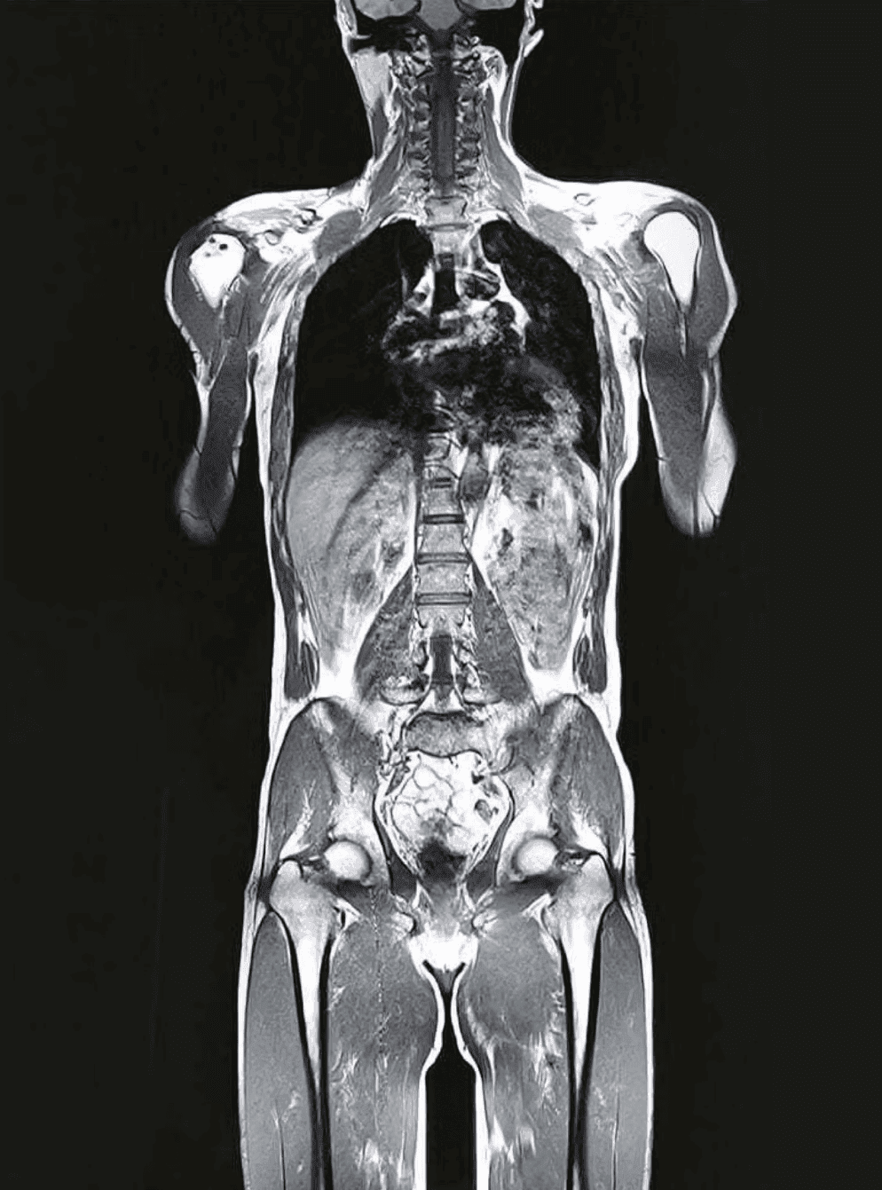 Full-body MRI coronal view — torso from neck through pelvis