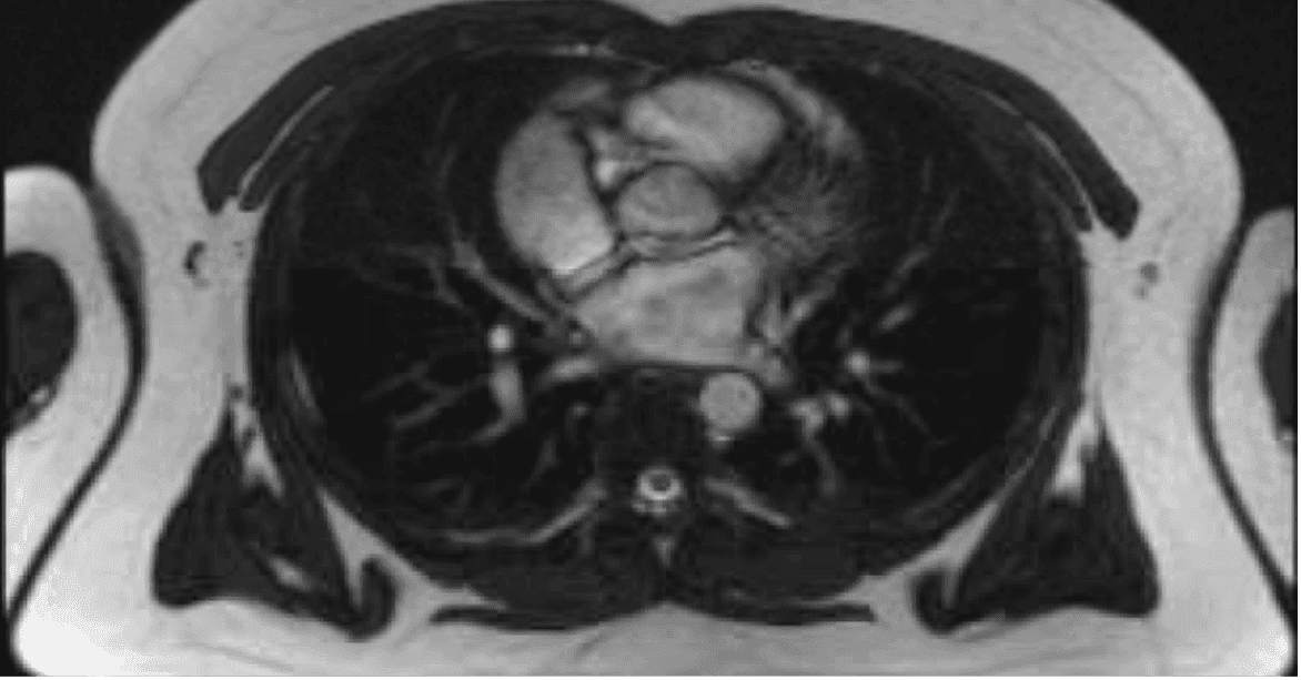 MRI axial slice — chest and heart region