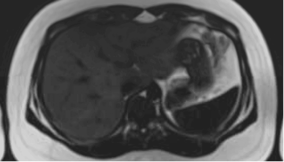 MRI axial slice — upper abdomen