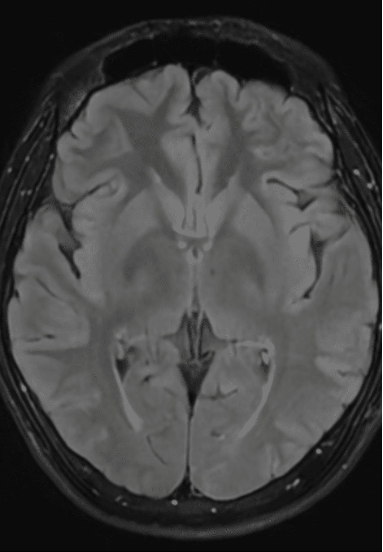 Brain MRI axial view — cerebral tissue and ventricular system