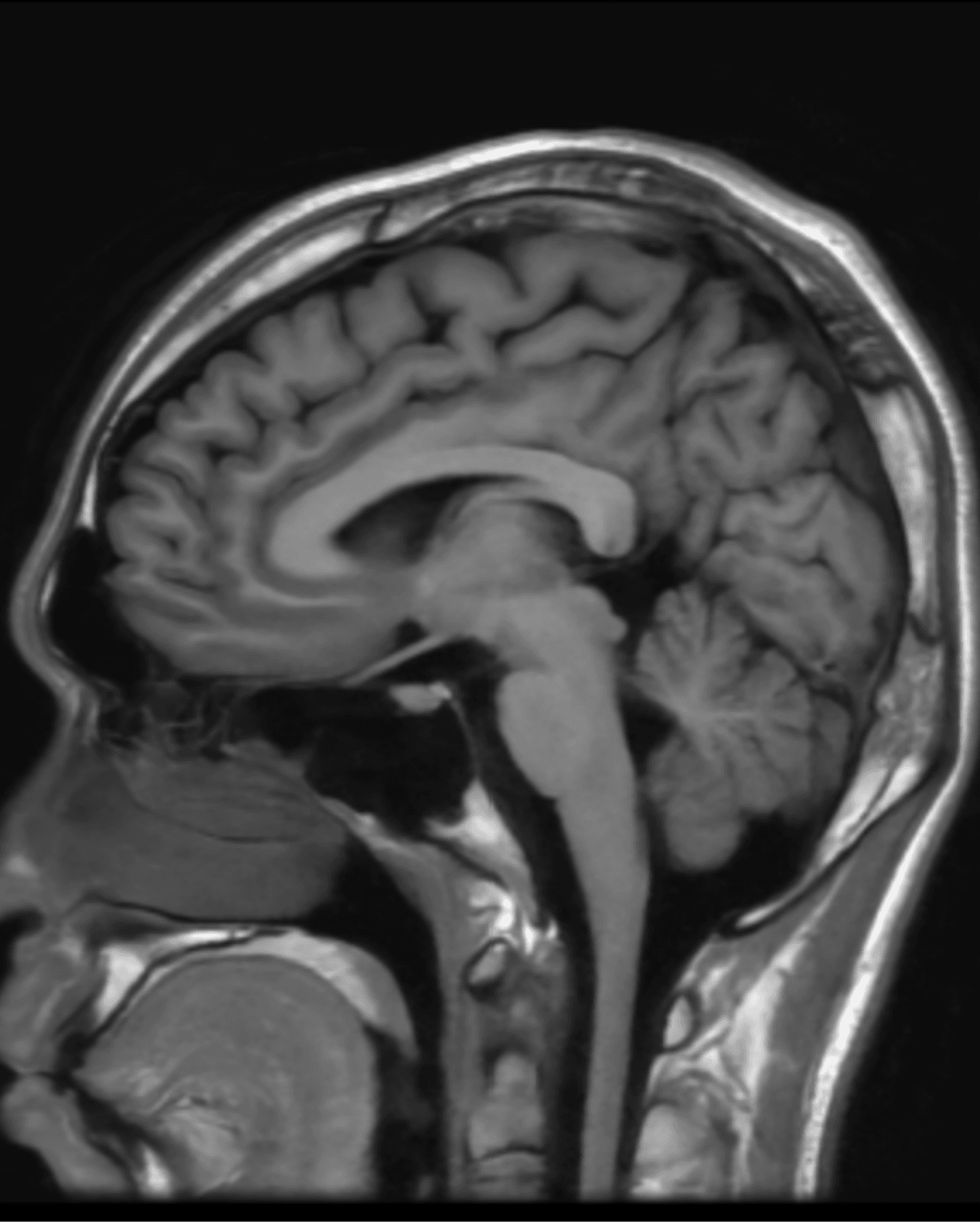 Brain MRI sagittal view — vasculature and pituitary region