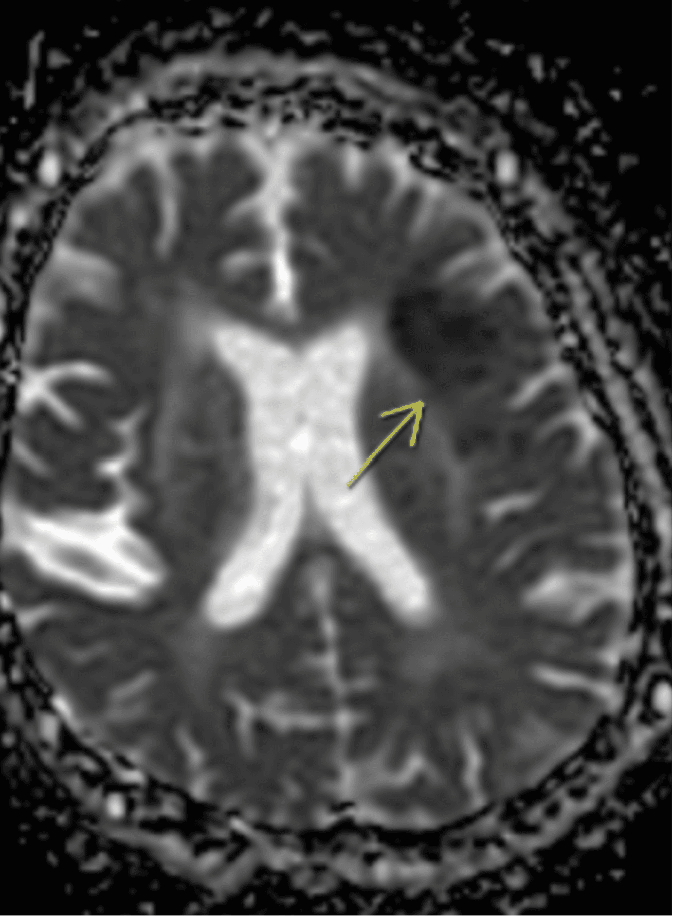 Brain MRI axial view — white matter and cranial nerve pathways