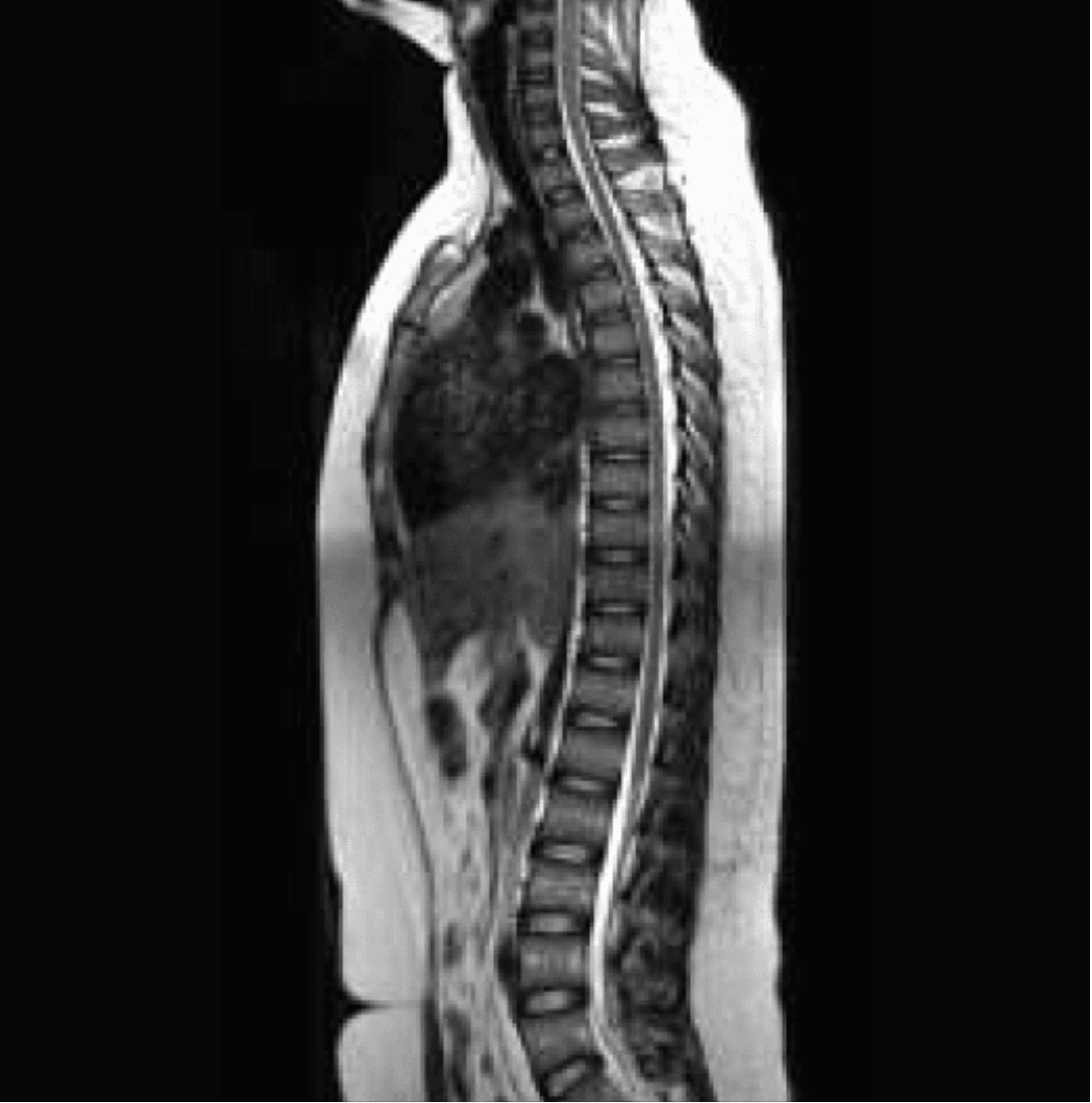 Spine MRI sagittal view — full spinal column