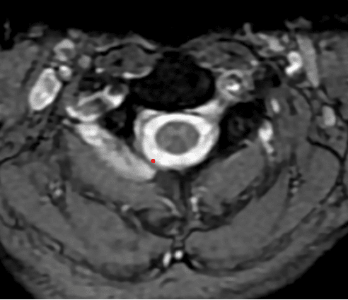 Spine MRI axial view — cross-section upper region