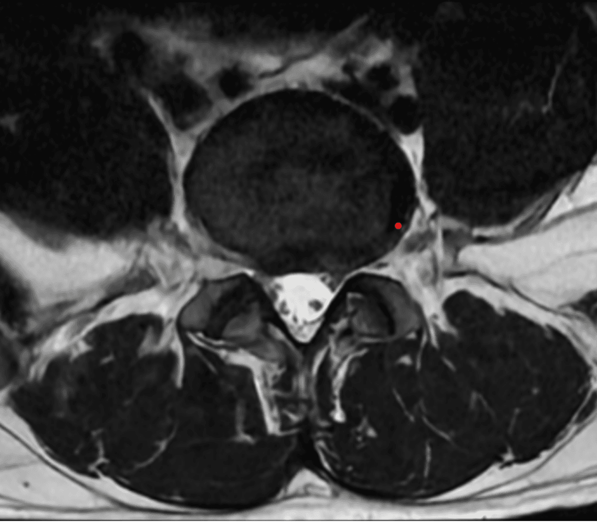 Spine MRI axial view — cross-section lower region